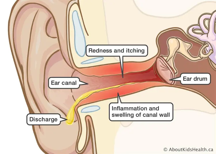 swimmers-ear