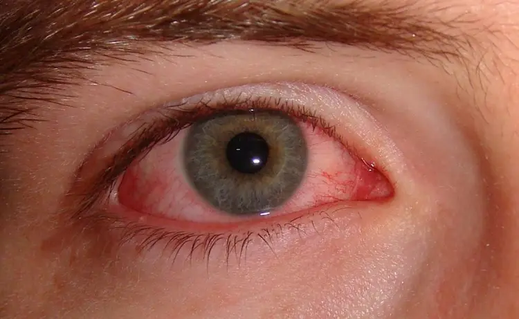 bloodshot-eyes-after-shower